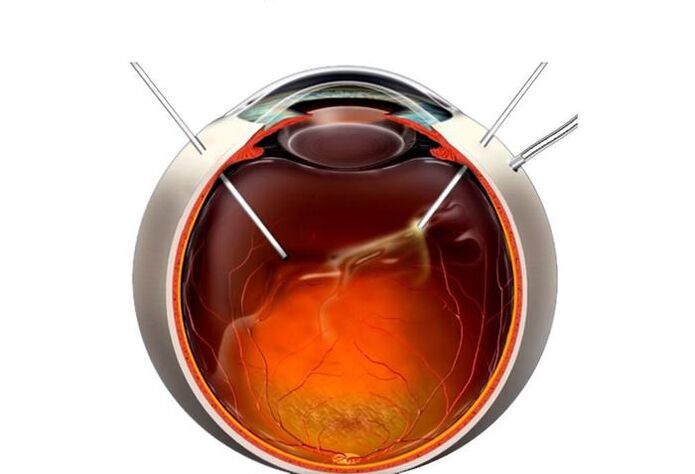 Vitectomy - an operation to reset the vision